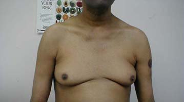 Gynecomastia: borstvorming bij mannen